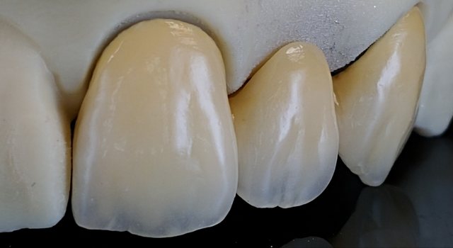 Anterior Crown 케이스 03