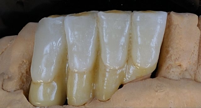 Anterior Restoration 케이스 07