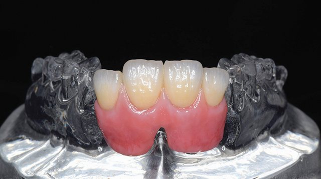 Denture 케이스 08