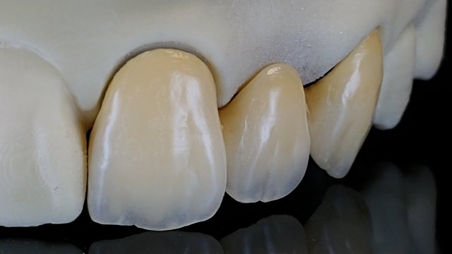 Anterior Crown 케이스 09